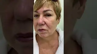 Глубокая подтяжка лица +медиальная платизмопластика в моём исполнении. Часть 1.