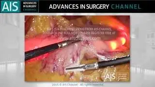 New device improves exposure during sleeve gastrectomy