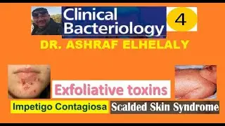 4-Bacteriology: Exfoliative toxin | Impetigo contagiosa | Staphylococcal scalded skin syndrome(SSSS)