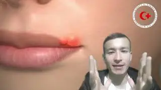 uchuq nima sababdan chiqadi. uyda davolash. Учуқ чиқса нима қилиш керак.