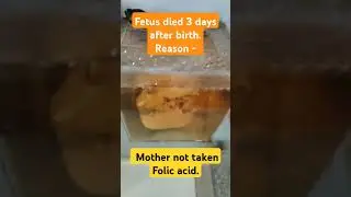 මිය ගිය කළලය -හේතුව ෆෝ.අ.නොගැනීම