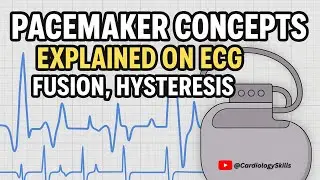 Pacemaker Concepts explained on ECG - Fusion, Hysteresis #cardiology  