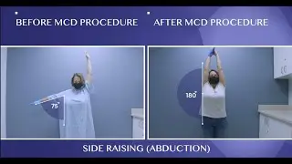 Frozen Shoulder Cured!