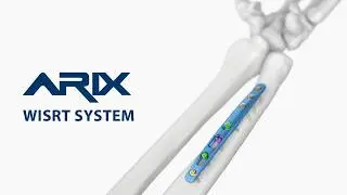 [ARIX OS] ARIX Ulna Osteotomy System