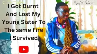 Burn Victim Survivor . I Found Beauty In My Scars