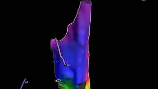Typical atrial flutter in Biotok Unity