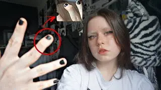 ЧТО С МОИМ ПАЛЬЦЕМ?(врачи мракобесы,буллинг, издевательства )