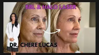 BBL and HALO Treatment Journey | Derms of Boca Raton | Dr. Chere Lucas Anthony