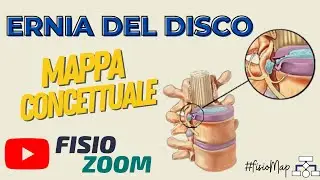 Ernia del disco/ #FisioMap