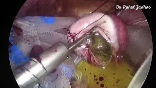 Urobag as endobag to prevent spillage at laparoscopy