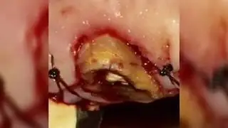 Surgical Crown Lengthening with Osteoplasty