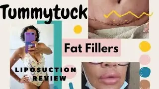 Want to get a Tummy Tuck Liposuction?  or even Lip fillers?  Pearl Signorile Vlog