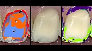 Dental Shade Matching - Translating Between Shade - Dental Shade Guides