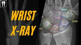 Age Assessment |Hand Wrist Radiographs| Growth and Development | Orthodontic | Anatomy of hand