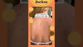 How to get rid of BACK ACNE finally.