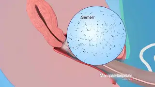 How to use Condoms for Men? | How to wear a Condom? - Manipal Hospitals