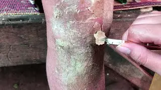 How to removal skin | callus removal skin flakes #50
