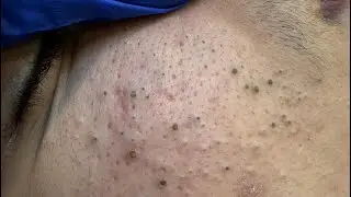 The Ultimate Facial Care Routine | Blackheads Removal, Acne Treatment & Deep Cleansing Techniques