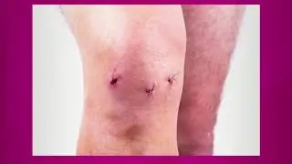 Arthroscopic Procedures for the Knee