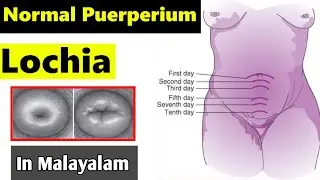Normal Puerperium in Malayalam (മലയാളം) | Lochia | Mr Nurse Manglish | Obstetrics & Gynecology | OBG
