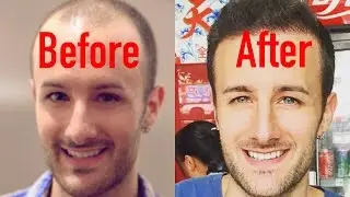 Hair Systems & Wigs vs. Hair Transplants