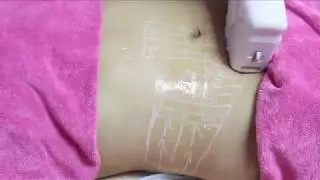 3d hifu MINI