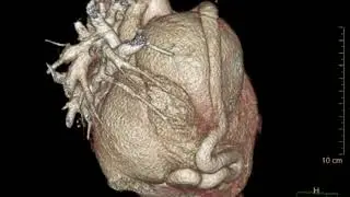 Surgical Management of a Giant Right Coronary Artery Aneurysm