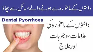 Dental Pyorrhoea | Symptoms, Causes, and Treatment | Urdu/Hindi