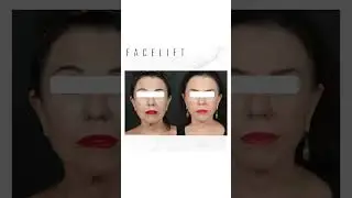 FACELIFT #youtubeshorts