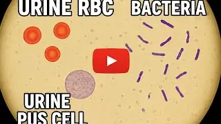 🔬 Microscopic view of Urine RBC & Pus Cells | Pathology Lab Test 🧪