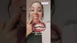 ¿Dientes APIÑADOS?🤔 ¡Mira este Cambiazo con IMPRESS!⁣⁣