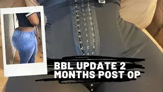 BBL Update!!! 2 Months Post Op