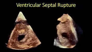 2D/3D-TOE assessment of VSR post infarction