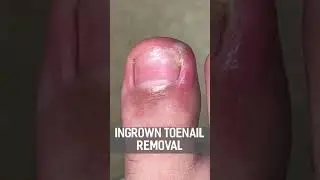 INGROWN TOENAIL REMOVAL! FULL VIDEO! 