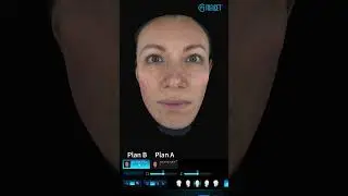 ISEMECO 3D D9 Skin Analyzer——Compare Function #skinanalyzer #skincare #beauty