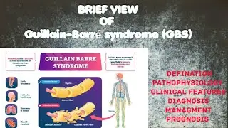 Guillain-Barré syndrome (GBS) #MADE_EASY. CUSES ,CLINCAL FEATURES AND TREATMENT