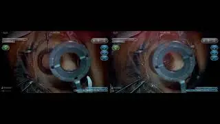 3D 手术：Yamane巩膜固定术