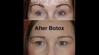 Botox Gone Wrong! - Before & After - My Story