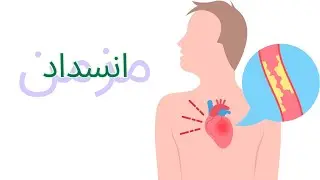 عندي انسداد مزمن في الشريان التاجي؟