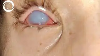 Ophthalmic Signs Cornea