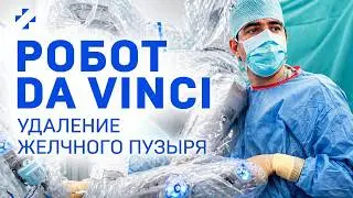 Удаление желчного пузыря роботом Da Vinci и эндоскопическое удаление камней из желчного протока.