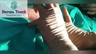 Breast implant in Gender change surgery from male to female.