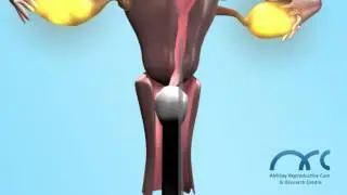 ICSI- 3D.Top IVF centers.Advanced Fertility treatments.Medical Tourism India, Infertility-ARC Centre