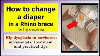 How to change a diaper while using a Rhino brace for hip dysplasia?