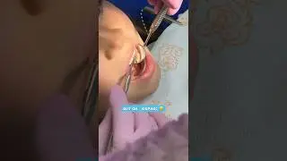ОБНАРУЖИЛИ КАРИЕС 🦠🫣 