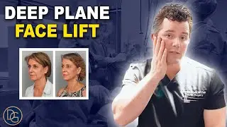 Face Lifts
