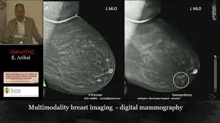 DIGITAL MAMMOGRAPHY