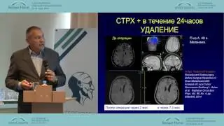 Различные методы стереотаксического облучения при метастатическом поражении головного мозга