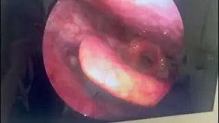 ￼￼ Vocal cord cysts