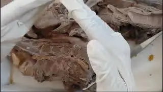 Sagittal section of HFN